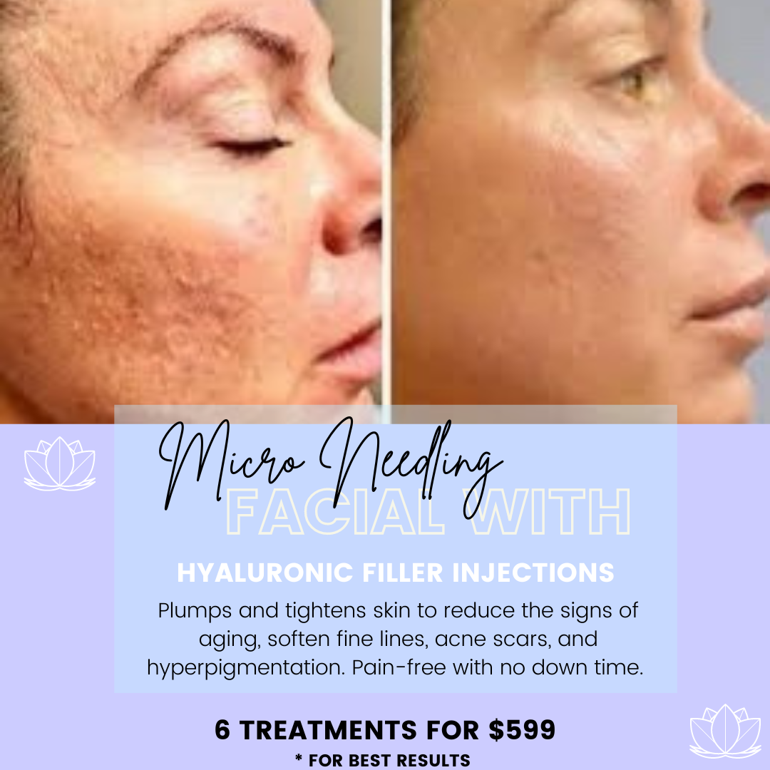 Micro Needling Facial with Hyaluronic Filler Injections-Six Treatment Package
